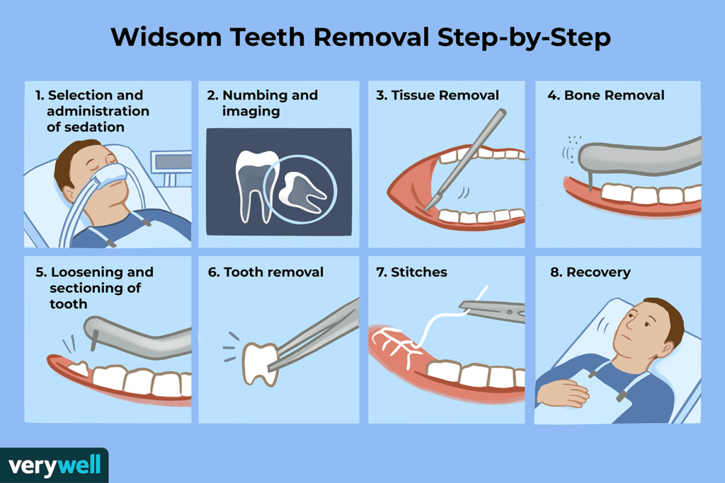 How To Take Care Of Wisdom Teeth Extraction